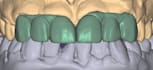 design your dental restorations