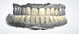 do waxup mockup and monolithic zirconia design using 3shape