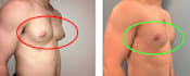 provide the guide to remove lower chest gyno problems