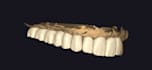 dental design with exocad