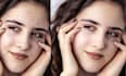 quickly remove pimples marks and dark spots, acne, from face
