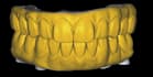 screw retained prosthesis crowns, bridges, full arch