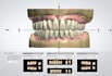 do denture design using 3shape