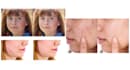 retouch your image remove pimples, wrinkles, acne and blemishes with photoshop