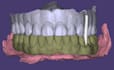 do expert dental design on exocad crowns, bridges and more