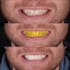do digital wax up dsd using exocad