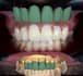 make dental designs on exocad crown x bridge  x implant bar