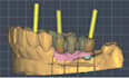 design bridges and crowns on implants
