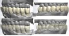 3shape exocad crown and bridge so cheap