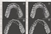 high quality dental 3d file meshing with meshmixer