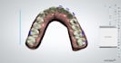 do dental clear aligner treatment planning on onyxceph, hit and 3shape analyzer