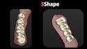design crown, bridge, and wax up using 3shape software