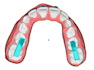 design custom clear aligner treatment plan