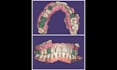 design custom trays, bite registration and denture on exocad