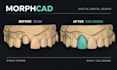 design dental crowns bridges and implants in exocad