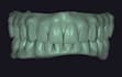 design full arches over implants on exocad