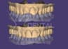 design crowns and bridges in exocad