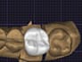 design crowns, bridges, onlays, maryland etc in exocad