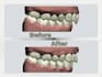 design best clear aligners treatment planning