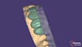 create a high quality digital smile design in exocad first crown free