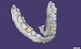 do dental design using exocad software based on your scans