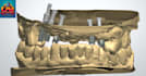 3shape design for crowns, implants, bridges, inlaysonlays, etc