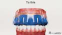 3d dental animation orthodontic animation 3d gum disease video medical animation