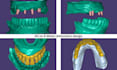 create high quality dental restorations using exocad