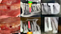 do implant planning, surgical guides, and stackable guides