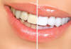 edit your teeth, align, whiten teeth, and remove braces