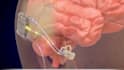 create 3d medical animation medical explainer ear surgical procedure animation