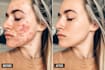 remove professionally acne or retouching your photos
