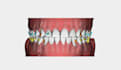 design precise clear aligner treatment plans for your cases