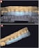design a precise bite splint , night guard in exocad  stl ready