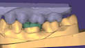 design crowns, bridges, veneers and implants using exocad