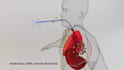 do stunning 3d medical animation surgical device and diagnostic device animation