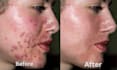 remove pimples and dark spots from the face and body