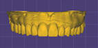 design crown and bridge using exocad
