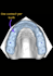 design dental splints in exocad ready for 3d printing