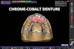 design partial dentures in exocad
