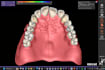 design digital total prostheses using exocad