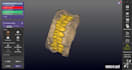 create accurate dental prosthesis designs using exocad
