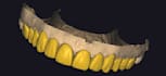 design a dental mock up design using exocad