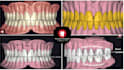 designe a professional full denture on exocad with high quality