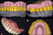 designe a partial denture , custom tray , baseplate on exocad with high quality