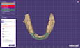 design professional dental cad designs in exocad