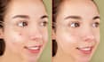 remove all the pimples and acne from your photo