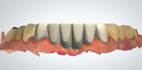 design highly precise perfect dental fixed prothesis using  3shape