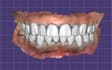 create accurate crowns and bridges using exocad