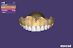 design dental crowns and bridges using exocad